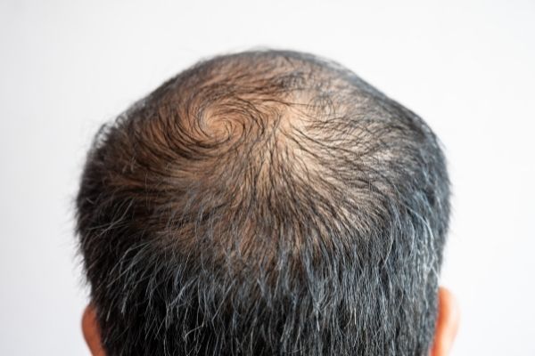 Nhổ tóc bạc gây dễ gây nên tình trạng hói đầu